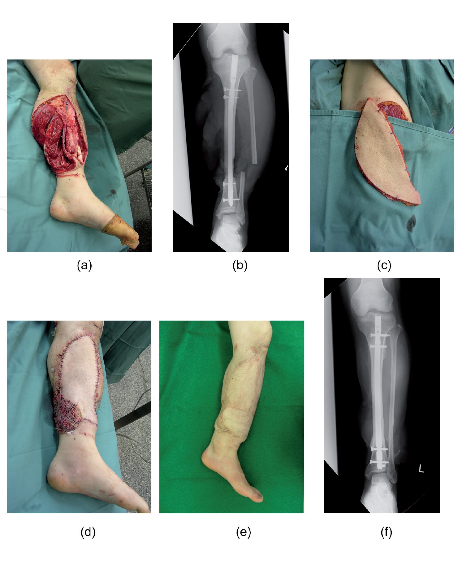 CRUSH INJURY FOOT, LOWER LIMB INJURIES AND LIMB SALVAGE: CRUSH